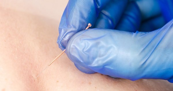 What Is Dry Needling Ready To Treat?
