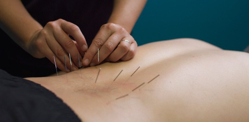 Getting To The Purpose Of Pain With Dry-Needling Therapy