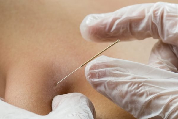 Dry Needling Helps Relieve Chronic Muscle Tension