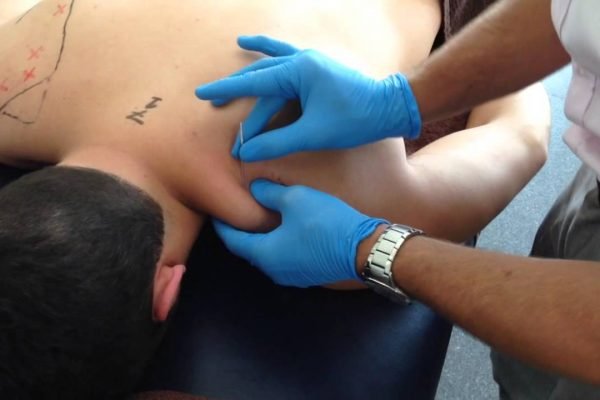 Dry Needling Practitioners