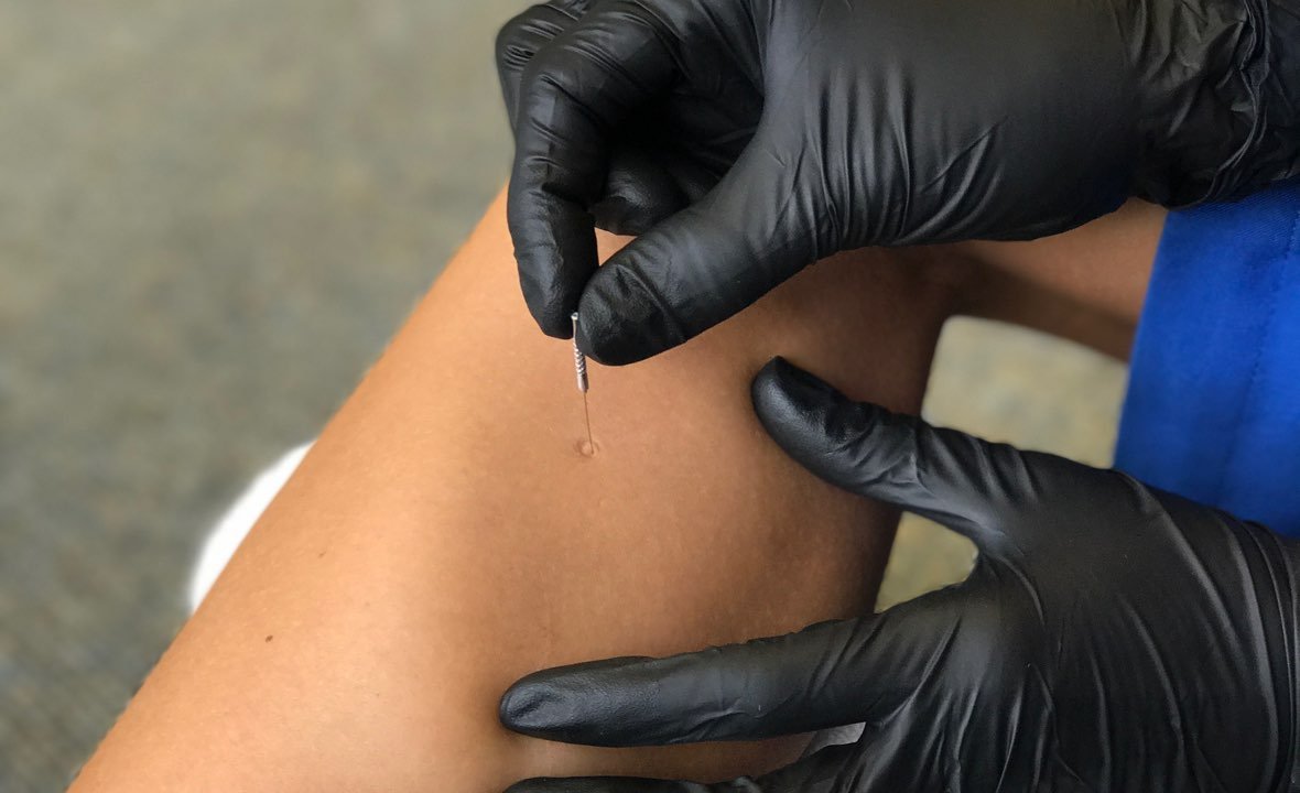 Is Trigger Purpose Dry-Needling A Style Of Acupuncture?