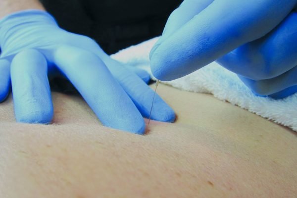 Dry Needling Explained