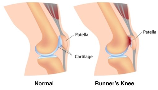 Patellar Chondromalacia