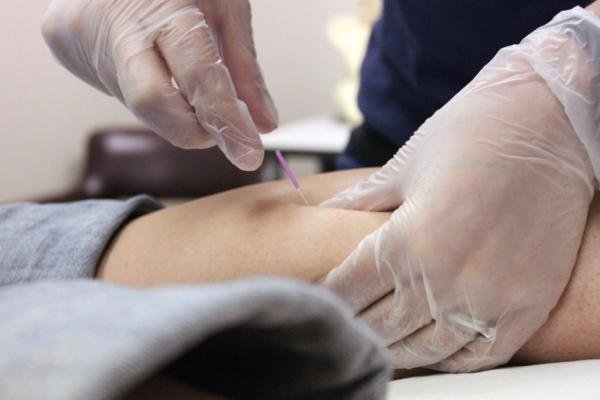 The Advantages Of Dry Needling
