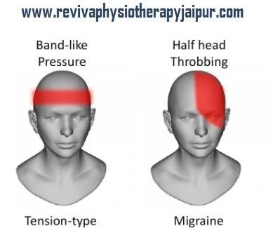 Difference between Migraine Headache and Tension Headache